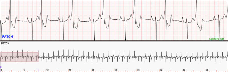 30-second 1-lead telemetry strip