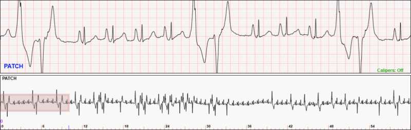 60-second 1-lead telemetry strip