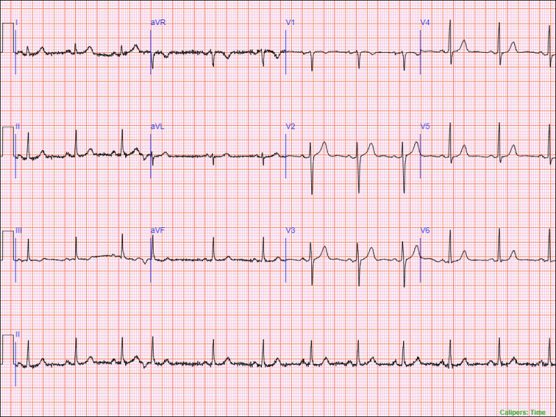 12 lead diagnostic ECG