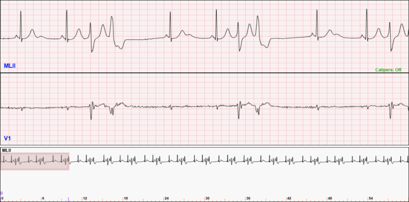 60-second 2-lead telemetry strip
