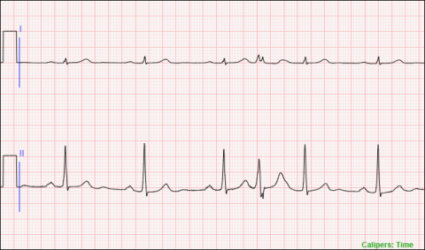 An Example of a 6 Second 2-Lead Telemetry Stripp
