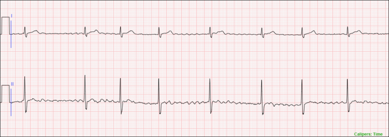 An Example of a 10 Second 2-Lead Telemetry Strip