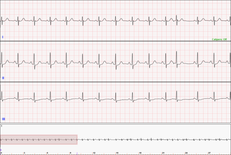 30-second 3-lead telemetry strip