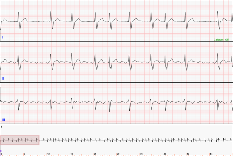 60-second 3-lead telemetry strip