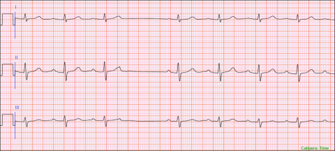 6 second three lead telemetry strip