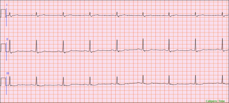 10 second three lead telemetry strip