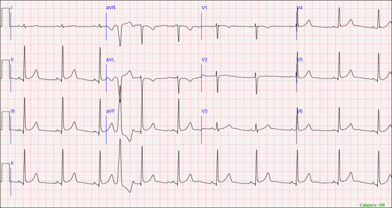 An Example of a Data-Based Diagnostic 12-Lead ECG
