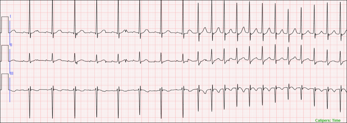 Short 3-lead telemetry strip used in the example.