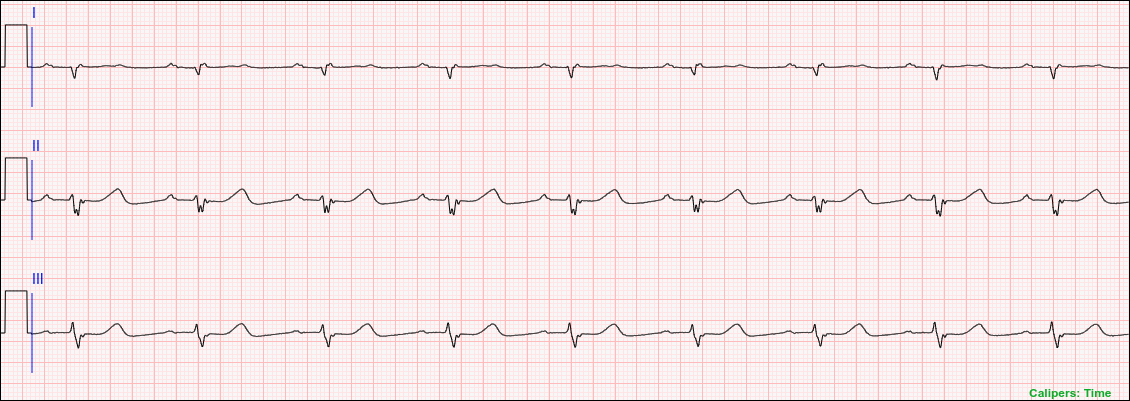 A Short Duration 3-Lead Telemetry Strip