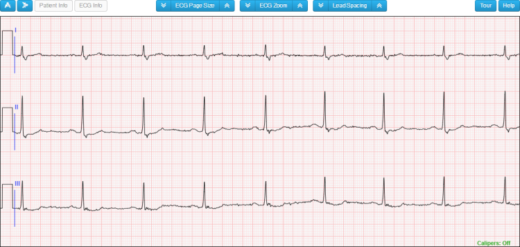 The Results ECG Section for Short Telemetry Strips