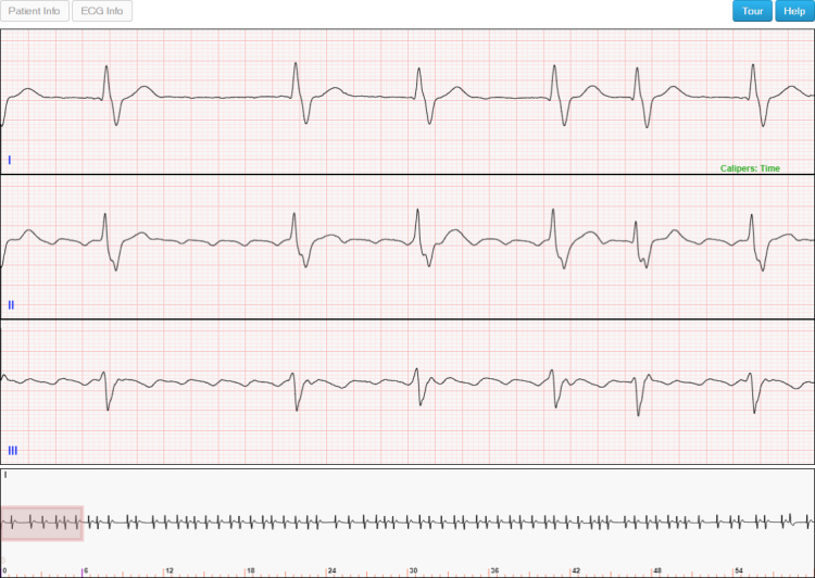The Results ECG Section for Long Telemetry ECGs